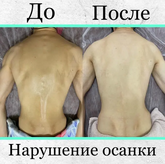 Осанка до и после курса лечебного массажа