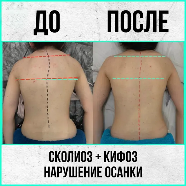 Осанка до и после курса лечебного массажа