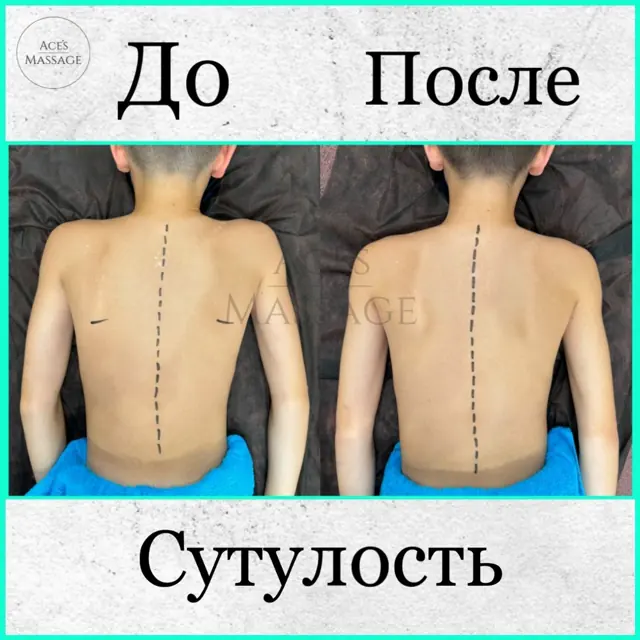 Осанка до и после курса лечебного массажа
