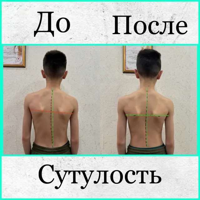 Осанка до и после курса лечебного массажа